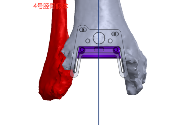 3D打印当“导航”，“元宇宙”预演手术——我院关节疾病诊疗中心利用数字骨科技术破解30年踝关节顽疾