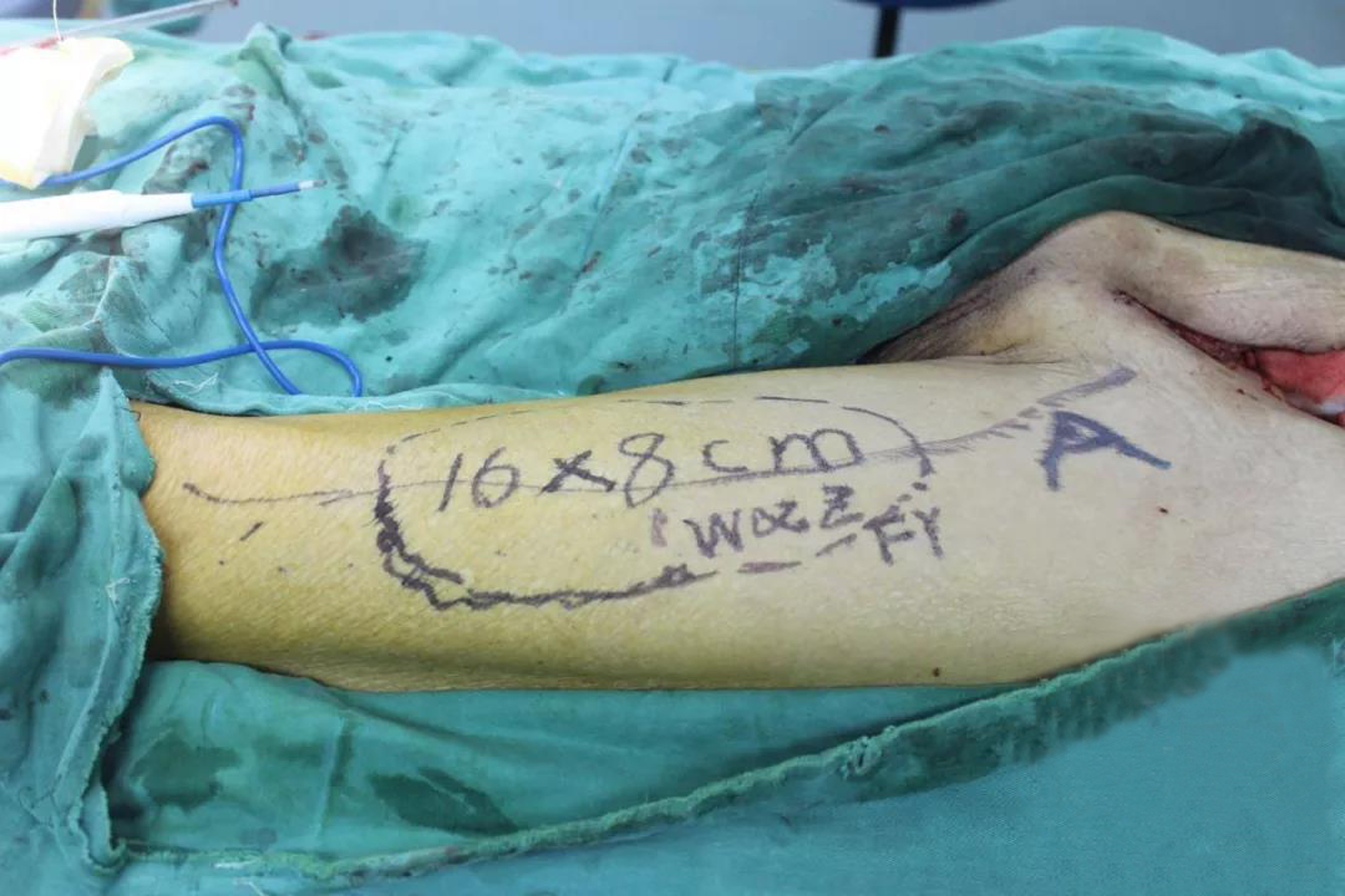 移花接木巧补腹壁巨大缺损——我院肝胆胰外科?疝外科联合多学科成功救治一例巨大腹壁平滑肌肉瘤患者 移花接木巧补腹壁巨大缺损——我院肝胆胰外科?疝外科联合多学科成功救治一例巨大腹壁平滑肌肉瘤患者