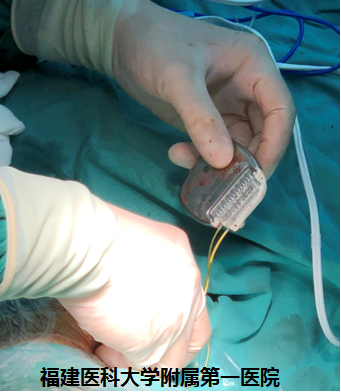 疼痛到什么部位,手术就控制到什么部位 ——我院神经外科林章雅教授带领团队精准施治脊髓损伤后顽固性疼痛 疼痛到什么部位,手术就控制到什么部位 ——我院神经外科林章雅教授带领团队精准施治脊髓损伤后顽固性疼痛