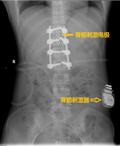 疼痛到什么部位,手术就控制到什么部位 ——我院神经外科林章雅教授带领团队精准施治脊髓损伤后顽固性疼痛 疼痛到什么部位,手术就控制到什么部位 ——我院神经外科林章雅教授带领团队精准施治脊髓损伤后顽固性疼痛
