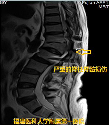 疼痛到什么部位,手术就控制到什么部位 ——我院神经外科林章雅教授带领团队精准施治脊髓损伤后顽固性疼痛 疼痛到什么部位,手术就控制到什么部位 ——我院神经外科林章雅教授带领团队精准施治脊髓损伤后顽固性疼痛