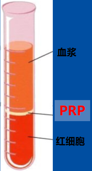 人体自带的神奇修复血浆PRP ——缓解关节疼痛,修复肌腱损伤,加速创面愈合 人体自带的神奇修复血浆PRP ——缓解关节疼痛,修复肌腱损伤,加速创面愈合