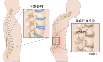 『附一科普』腰背部疼痛一定是腰椎间盘突出吗？这种情况需警惕