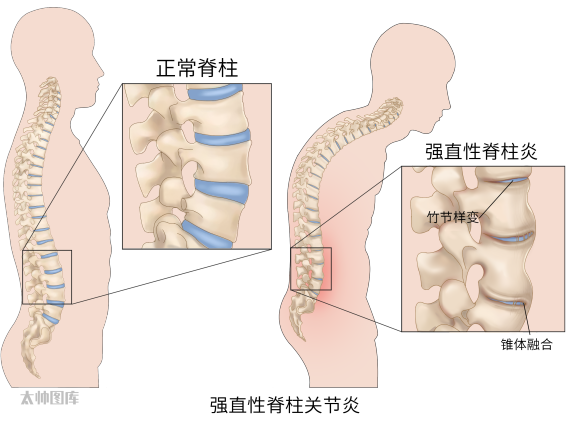 『附一科普』腰背部疼痛一定是腰椎间盘突出吗？这种情况需警惕