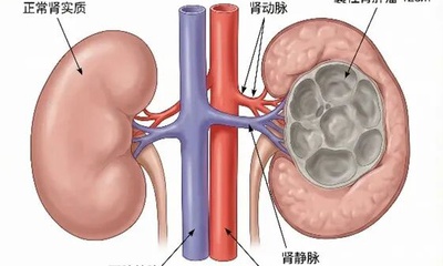 『附一医讯』“机器人医生”助力，福医附一医院泌尿外科团队挑战生命禁区，成功施行12CM囊性肾癌保肾手术