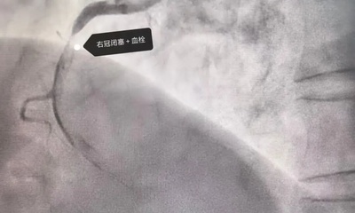 『附一医讯』坚守生命防线！福医附一医院国庆假期救治20名急性心肌梗死患者！