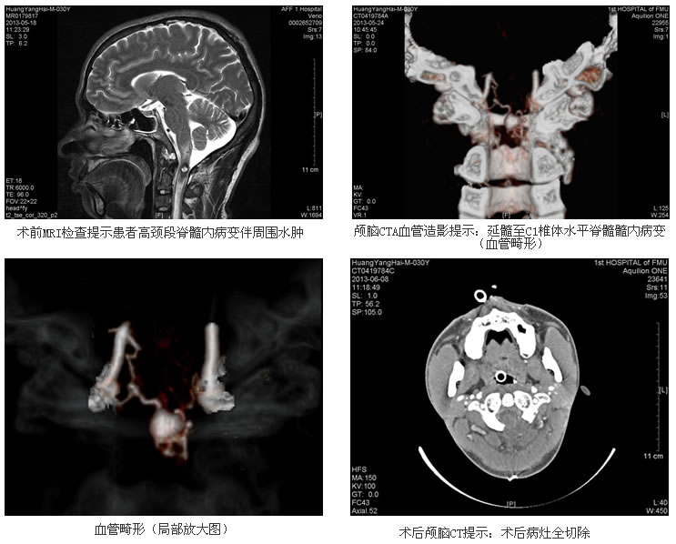 年青小伙突发顽疾难确诊 神经外科专家妙手解危难——我院成功为高颈段脊髓内血管畸形患者实施显微精准手术 年青小伙突发顽疾难确诊 神经外科专家妙手解危难——我院成功为高颈段脊髓内血管畸形患者实施显微精准手术