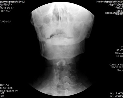 康复科成功开展吞咽造影录像检查与评估相关技术 康复科成功开展吞咽造影录像检查与评估相关技术