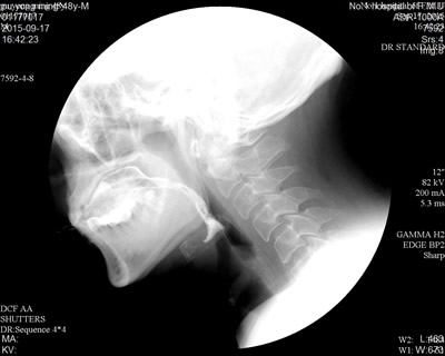 康复科成功开展吞咽造影录像检查与评估相关技术 康复科成功开展吞咽造影录像检查与评估相关技术