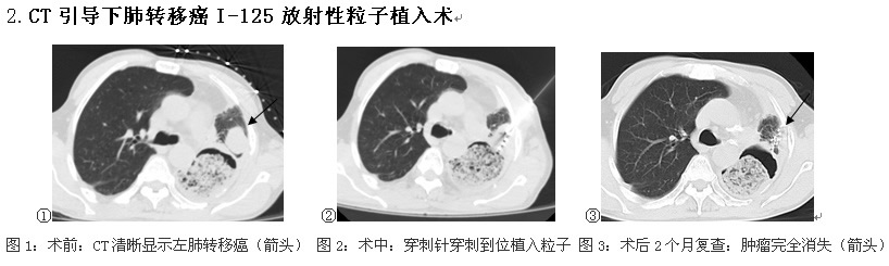 前进中的福建医科大学附属第一医院介入科 前进中的福建医科大学附属第一医院介入科