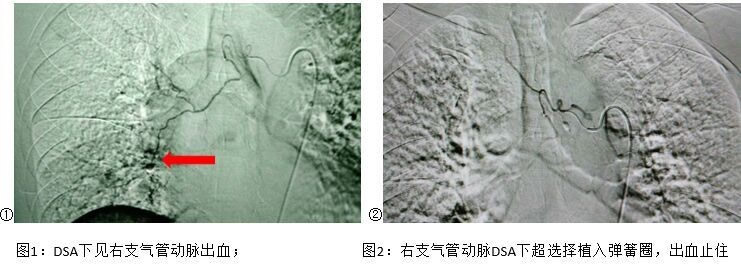 前进中的福建医科大学附属第一医院介入科 前进中的福建医科大学附属第一医院介入科