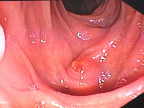 我院肝胆胰外科成功开展多例胃毕-Ⅱ式术后ERCP 我院肝胆胰外科成功开展多例胃毕-Ⅱ式术后ERCP