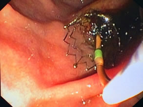 我院肝胆胰外科成功开展多例胃毕-Ⅱ式术后ERCP 我院肝胆胰外科成功开展多例胃毕-Ⅱ式术后ERCP