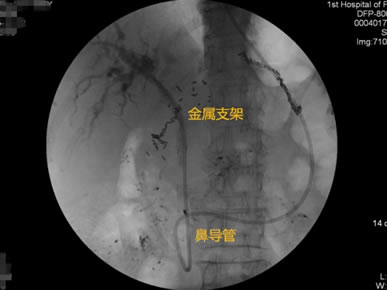 我院肝胆胰外科成功开展多例胃毕-Ⅱ式术后ERCP 我院肝胆胰外科成功开展多例胃毕-Ⅱ式术后ERCP