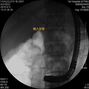 我院肝胆胰外科成功开展多例胃毕-Ⅱ式术后ERCP 我院肝胆胰外科成功开展多例胃毕-Ⅱ式术后ERCP