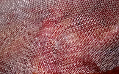 腹腔镜疝修补术优势多:钻3孔补6洞 腹腔镜疝修补术优势多:钻3孔补6洞