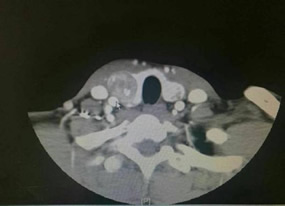 『改善医疗服务行动纪实』--甲状腺乳腺外科张惠灏副主任医师采用改良法开展甲状腺癌颈部淋巴结清扫术