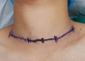 『改善医疗服务行动纪实』--甲状腺乳腺外科张惠灏副主任医师采用改良法开展甲状腺癌颈部淋巴结清扫术