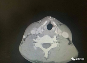 『改善医疗服务行动纪实』--甲状腺乳腺外科张惠灏副主任医师采用改良法开展甲状腺癌颈部淋巴结清扫术