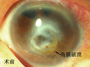 移花接木  延续光明--眼科成功开展我院首例生物角膜移植术