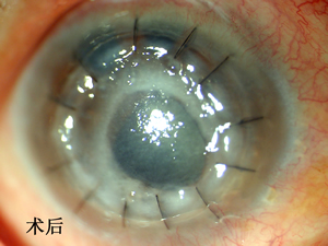 移花接木  延续光明--眼科成功开展我院首例生物角膜移植术
