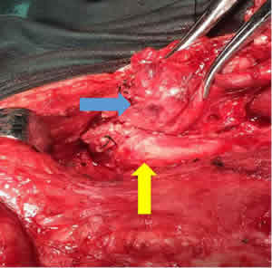 我院成功开展福建省首例颈动脉侵犯的喉恶性肿瘤动脉重建术