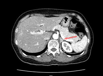 我院成功开展肾上腺静脉采血为实现高血压精准医疗迈出坚实一步