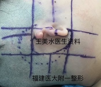 福建医大附一医院整形外科王美水主任医师在韩国大邱加图立大学医学中心(DCUMC)成功开展该院首例小耳症Nagata法耳再造手术