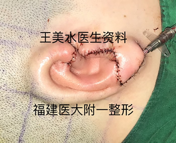 福建医大附一医院整形外科王美水主任医师在韩国大邱加图立大学医学中心(DCUMC)成功开展该院首例小耳症Nagata法耳再造手术