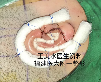 福建医大附一医院整形外科王美水主任医师在韩国大邱加图立大学医学中心(DCUMC)成功开展该院首例小耳症Nagata法耳再造手术