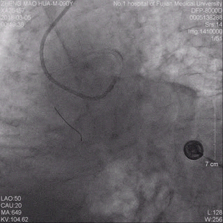 我院胸痛中心成功抢救一名高龄台胞患者