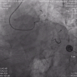 我院胸痛中心成功抢救一名高龄台胞患者