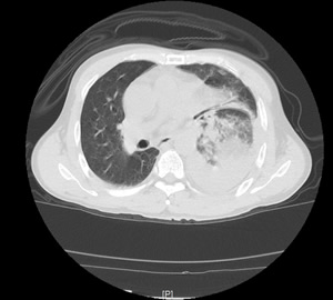 努力践行新医改,把分级诊疗和双向转诊落到实处——记一例车祸多发伤急危重症患者的MDT救治 努力践行新医改,把分级诊疗和双向转诊落到实处——记一例车祸多发伤急危重症患者的MDT救治