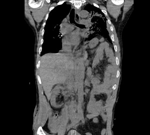 努力践行新医改,把分级诊疗和双向转诊落到实处——记一例车祸多发伤急危重症患者的MDT救治 努力践行新医改,把分级诊疗和双向转诊落到实处——记一例车祸多发伤急危重症患者的MDT救治