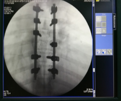 我院手术室联合多学科圆满完成一例全身多发性骨折孕妇优质手术护理