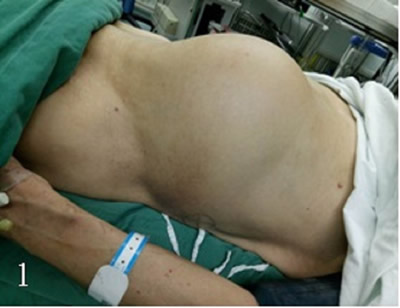 泌尿外科二区成功为一名患者切除巨大肾肿瘤 泌尿外科二区成功为一名患者切除巨大肾肿瘤