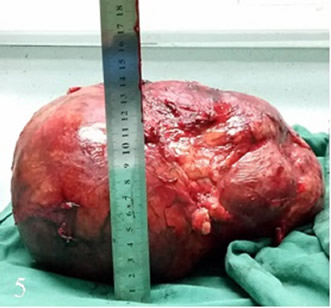 泌尿外科二区成功为一名患者切除巨大肾肿瘤 泌尿外科二区成功为一名患者切除巨大肾肿瘤