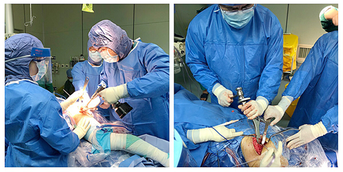 艾滋患者股骨头坏死 关节置换手术被拒我院骨科关爱艾滋患者伸援手 分期双侧关节置换缓病痛 艾滋患者股骨头坏死 关节置换手术被拒我院骨科关爱艾滋患者伸援手 分期双侧关节置换缓病痛