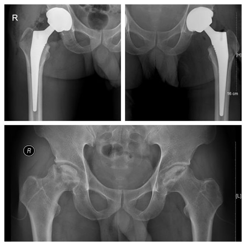 艾滋患者股骨头坏死 关节置换手术被拒我院骨科关爱艾滋患者伸援手 分期双侧关节置换缓病痛 艾滋患者股骨头坏死 关节置换手术被拒我院骨科关爱艾滋患者伸援手 分期双侧关节置换缓病痛